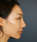 Feel Beautiful - Nose Revision 25 - Before Photo